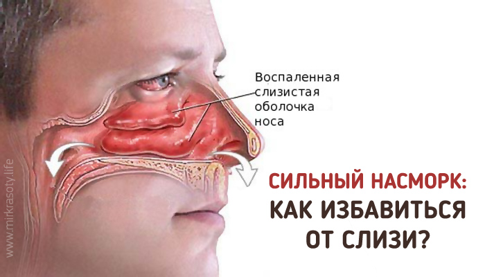 Как избавится от насморка в домашних условиях за один день