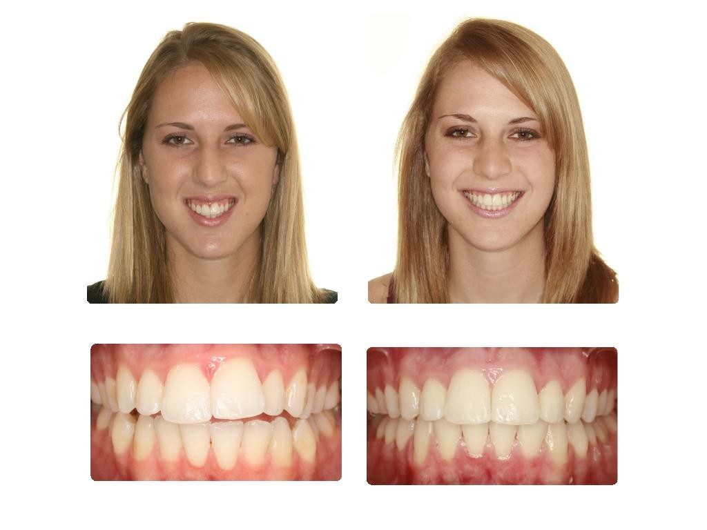 949_do-i-posle-invisalign-3616-1024x768.jpg